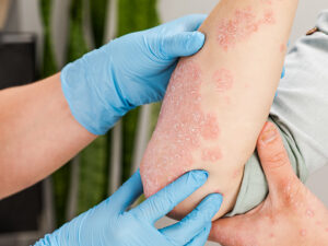 derma-Praxis Vest Hautarztpraxis Berufsassoziierte Erkrankungen